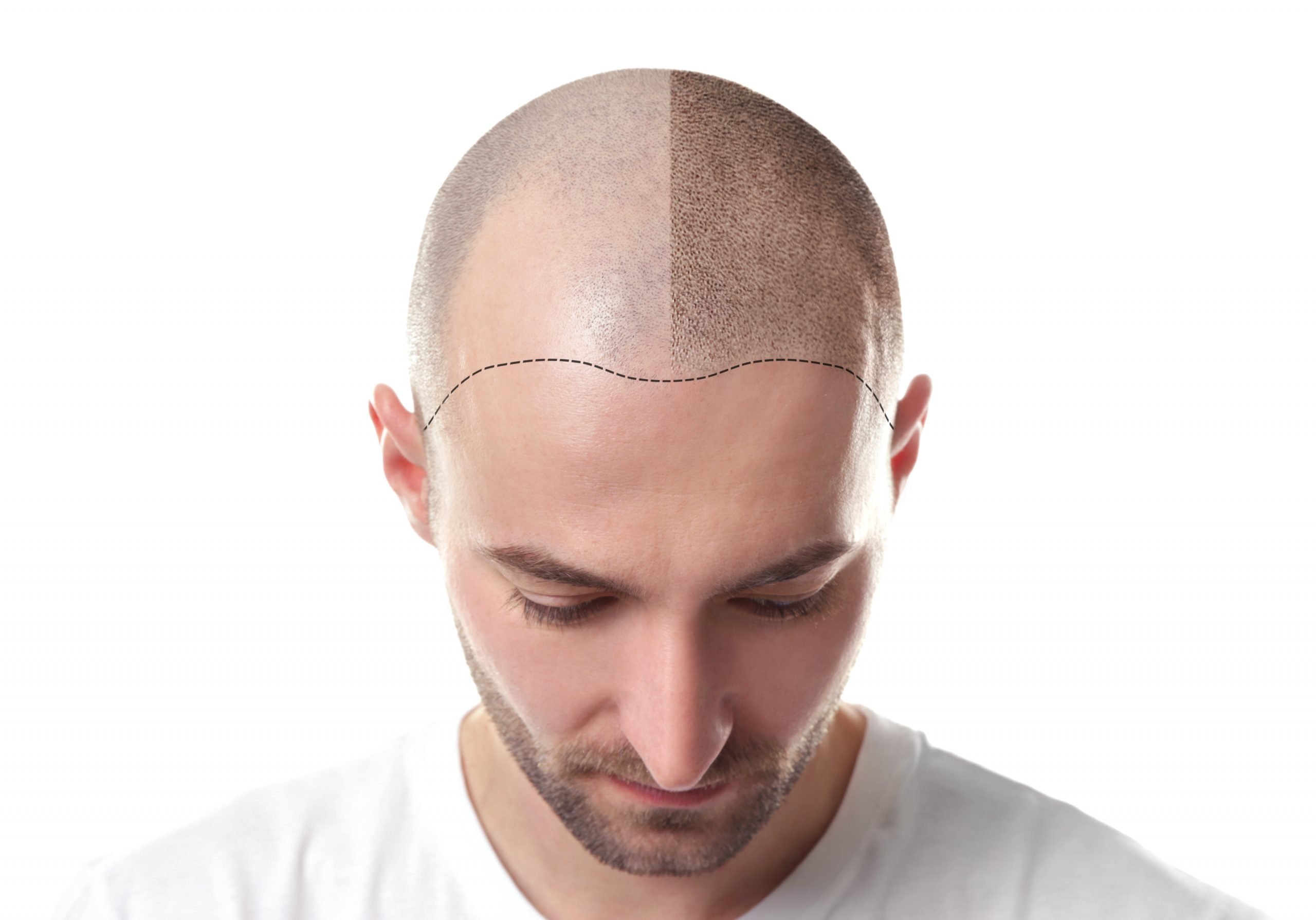 Why Is it Important to Choose the Right Scalp Micropigmentation Specialist for the Procedure 